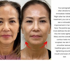 Ultraformer Face & Neck