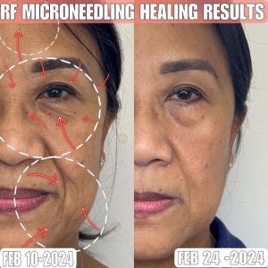 Microneedling RF