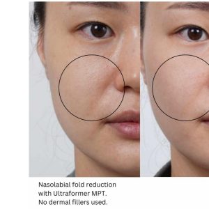 Ultraformer Partial Face Flower Cheek, Smile Line